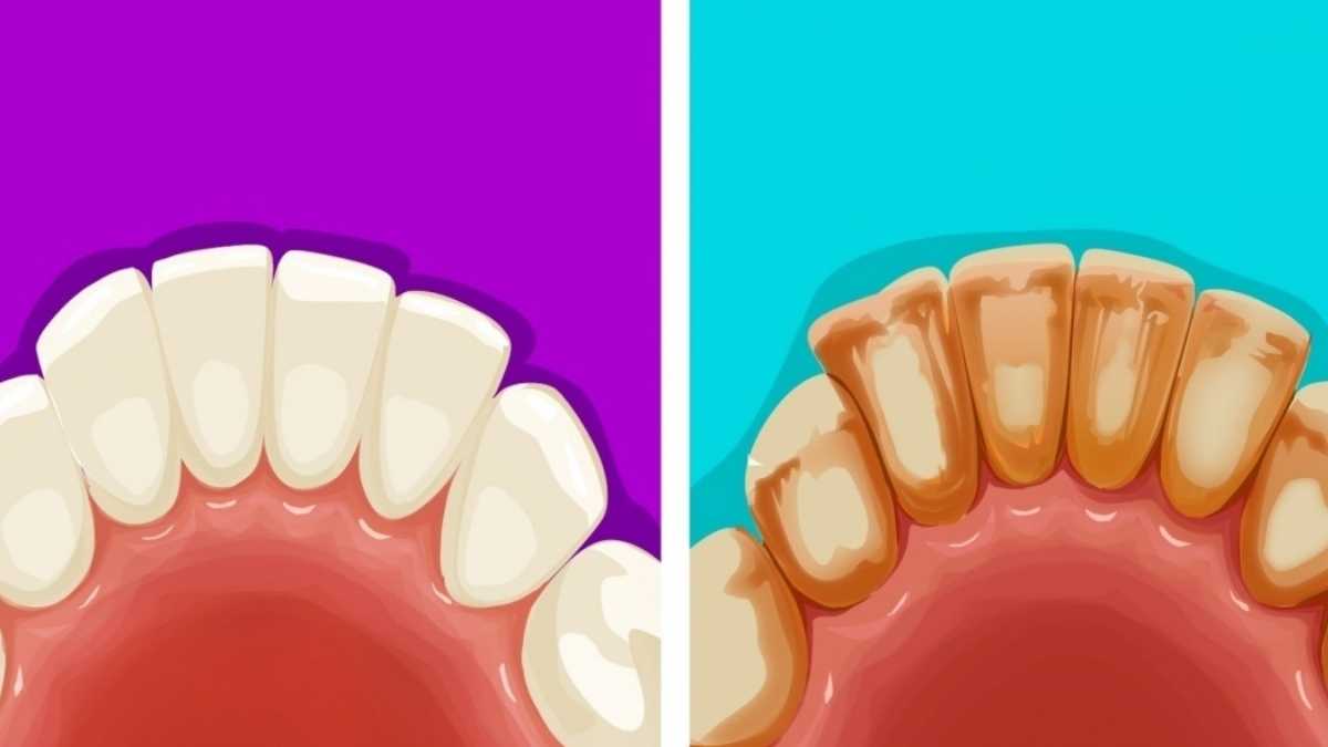 3 moyens naturels pour éliminer le tartre dentaire